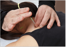 肩のトリガーポイント鍼治療法